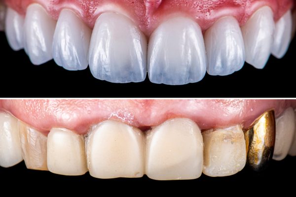 Creating,New,Smile,With,Emax,Crowns,And,Veneers,Bl2,Color