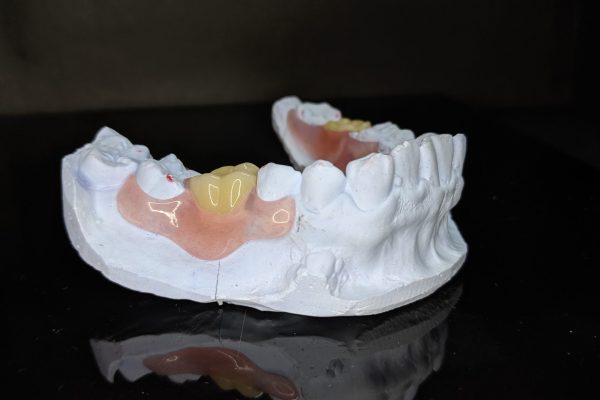 Flexi,Partial,Denture,Made,From,Thermosens,Material