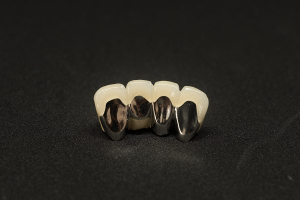 Porcelain,Fused,To,Metal,Bridge,Of,Lower,Anterior,Teeth,From