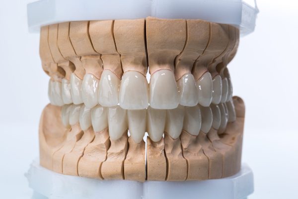 Dental,Zircon,Ceramic,Crowns,On,Model,/,Two,Jaw